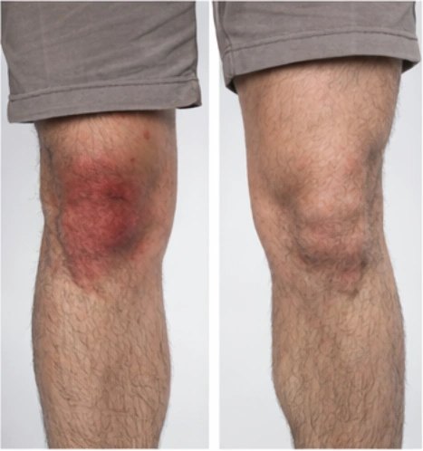 Persistent Swelling (Effusion)