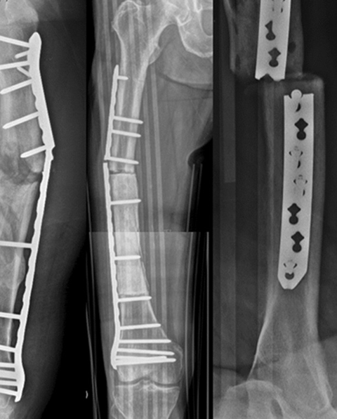 Broken Plate or Bent Nail